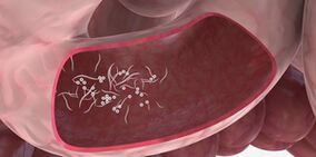 Uporaba trojčkov za odstranjevanje zajedavcev