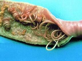 Vzroki parazitov v človeškem telesu